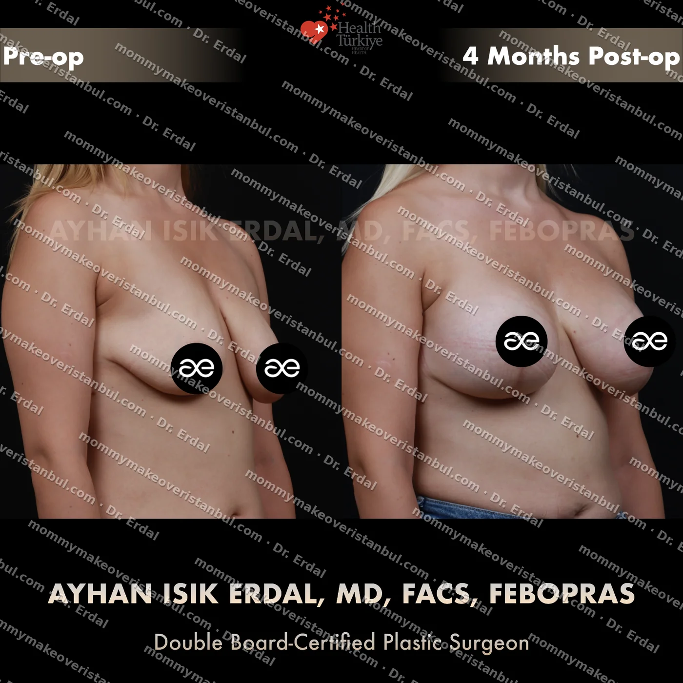 Breast lift + implants (300 cc) — patient case blwi-202-hg, view oblique at 4 months post-op