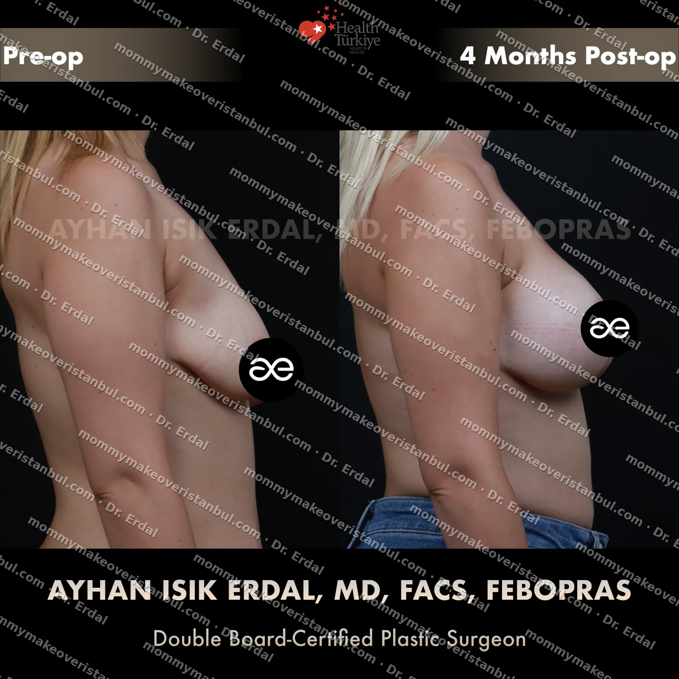 Breast lift + implants (300 cc) — patient case blwi-202-hg, view side at 4 months post-op