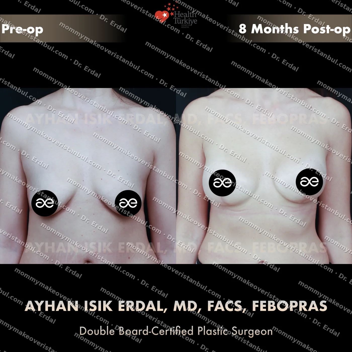 Breast lift + implants — patient case blwi-251-hibb, view front at 4 months post-op