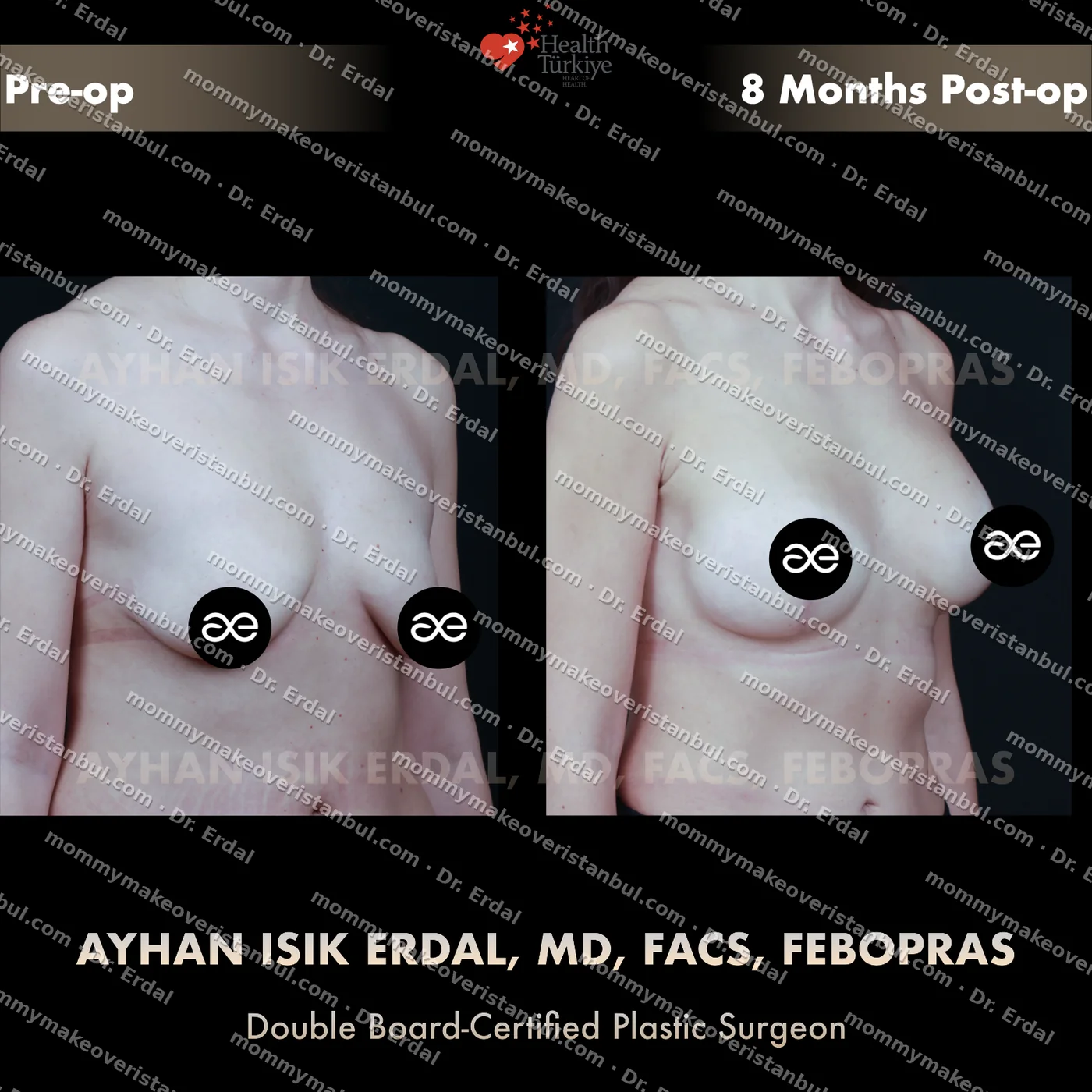 Breast lift + implants — patient case blwi-251-hibb, view oblique at 4 months post-op