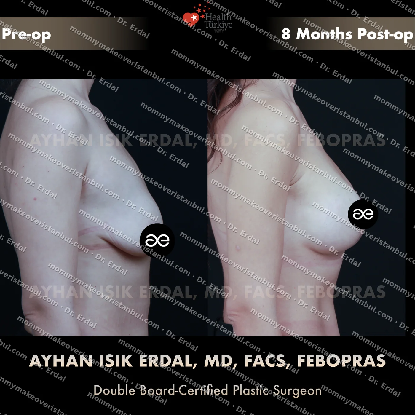 Breast lift + implants — patient case blwi-251-hibb, view side at 4 months post-op
