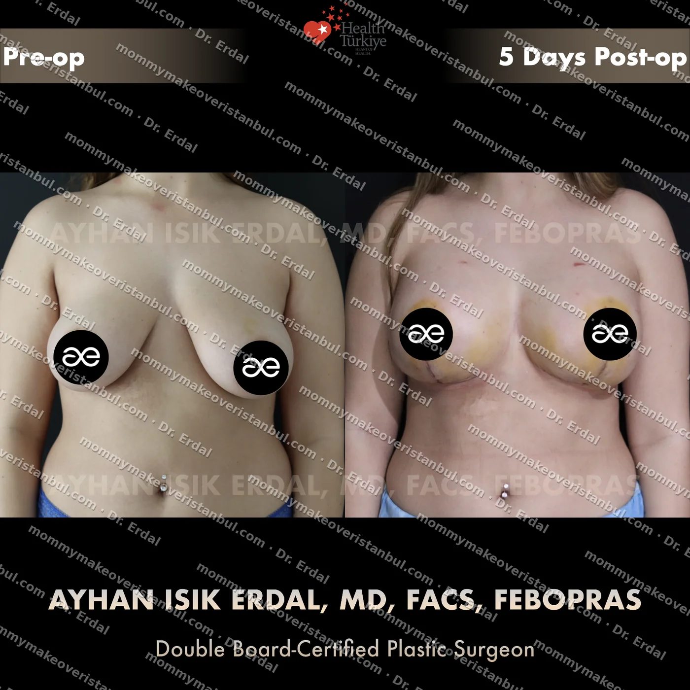 Breast lift + implants — patient case blwi-34-cbs, view front at 4 months post-op