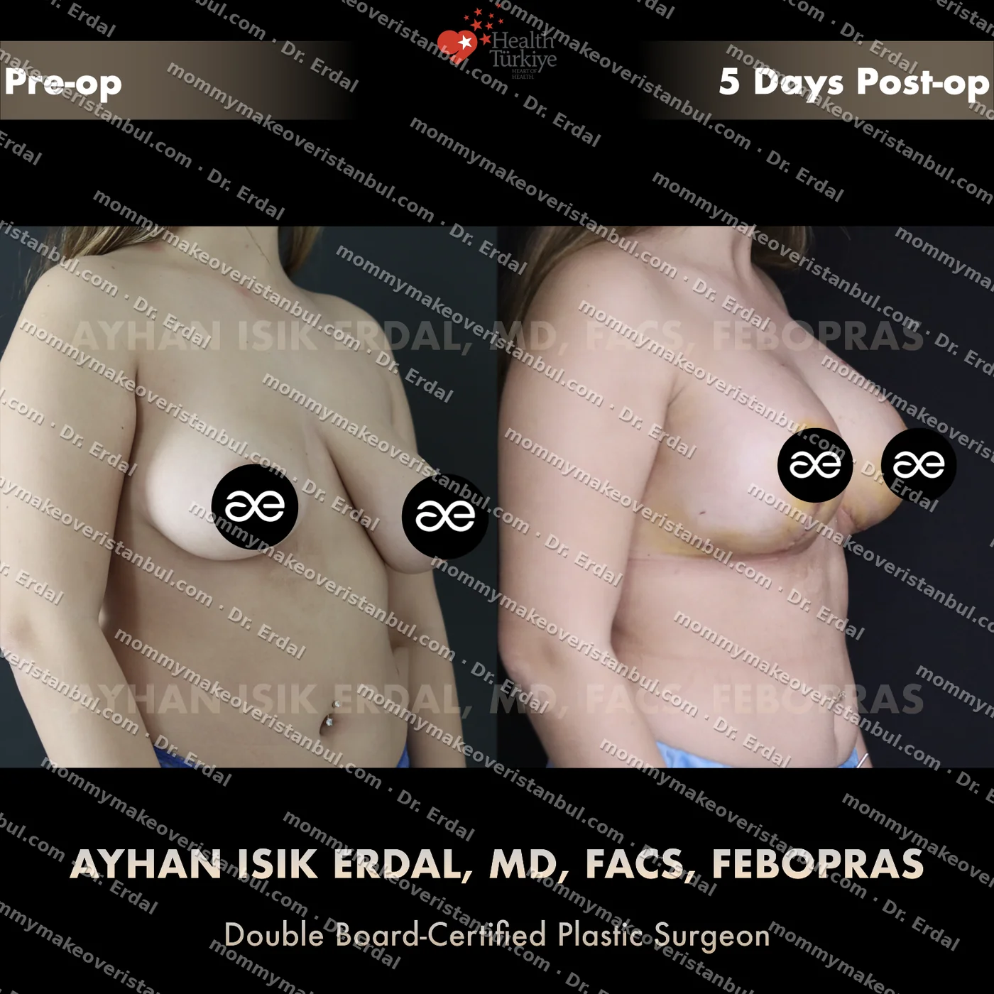Breast lift + implants — patient case blwi-34-cbs, view oblique at 4 months post-op