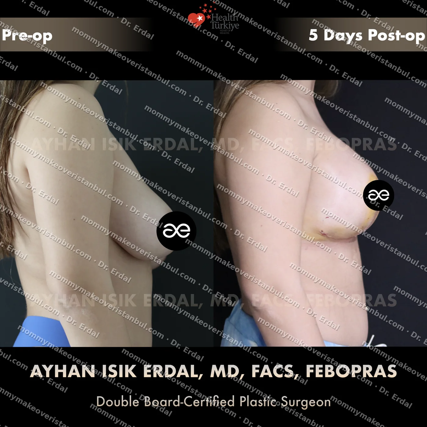 Breast lift + implants — patient case blwi-34-cbs, view side at 4 months post-op