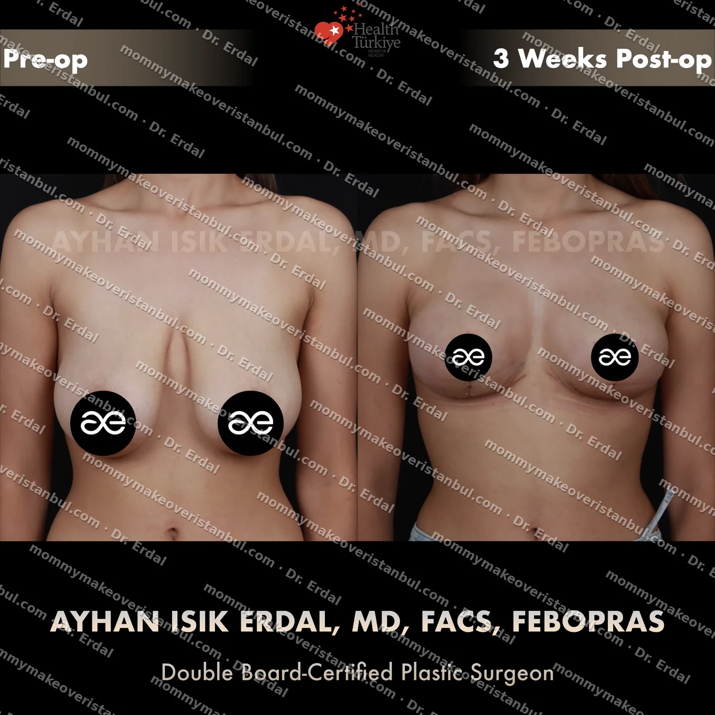 Breast lift (no implants) — patient case blwo-133-ic, view front at 4 months post-op