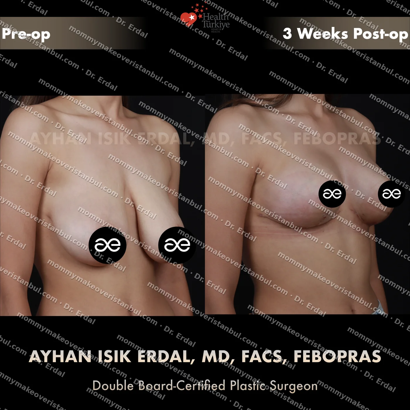 Breast lift (no implants) — patient case blwo-133-ic, view oblique at 4 months post-op