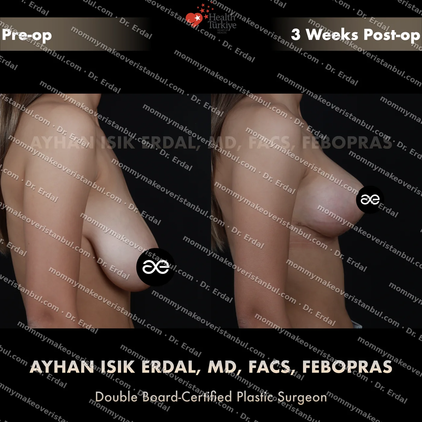 Breast lift (no implants) — patient case blwo-133-ic, view side at 4 months post-op