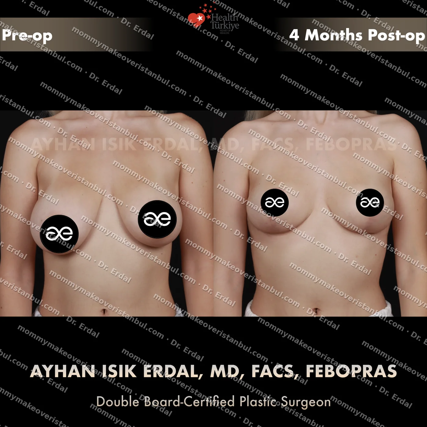 Breast lift (no implants) — patient case blwo-144-de, view front at 4 months post-op
