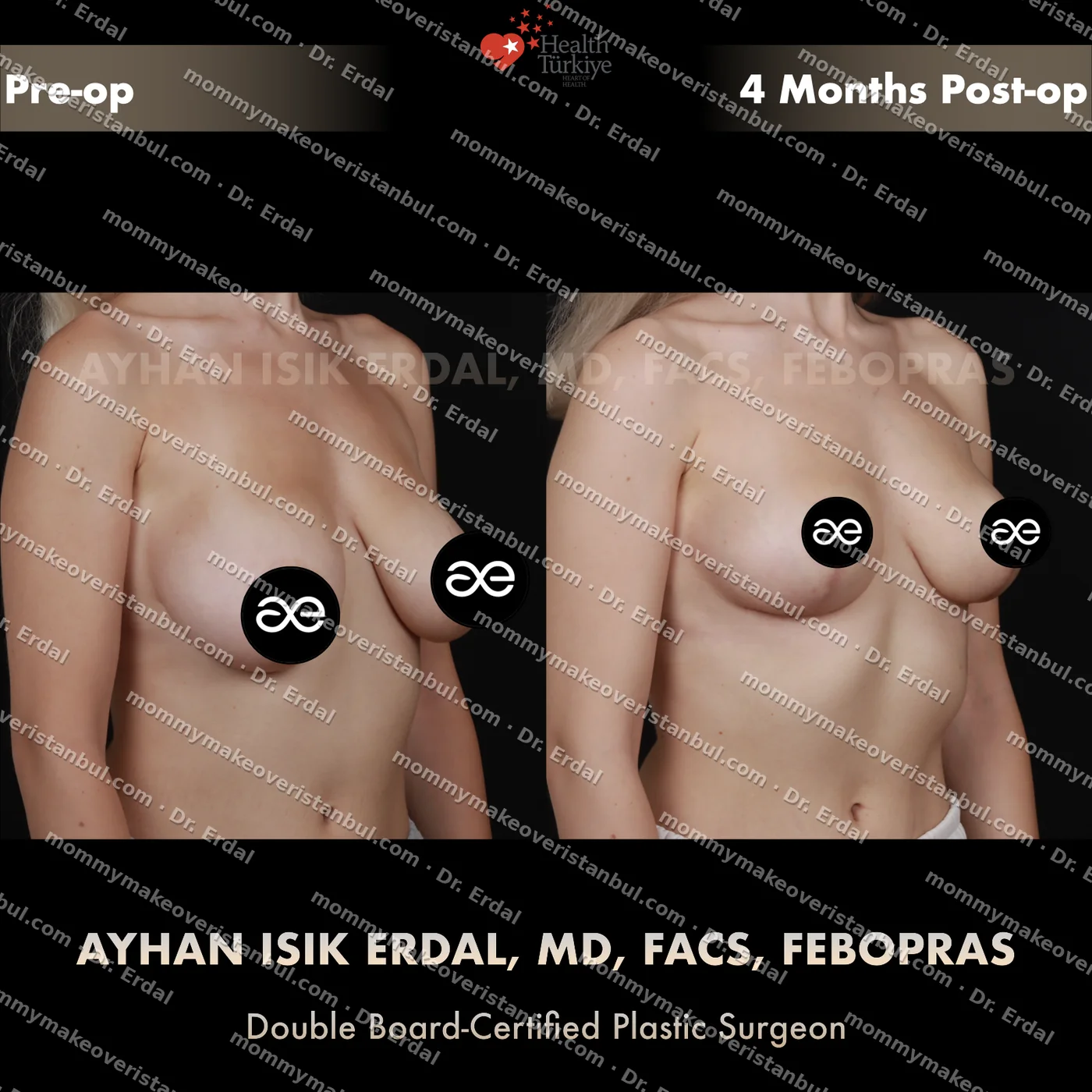 Breast lift (no implants) — patient case blwo-144-de, view oblique at 4 months post-op