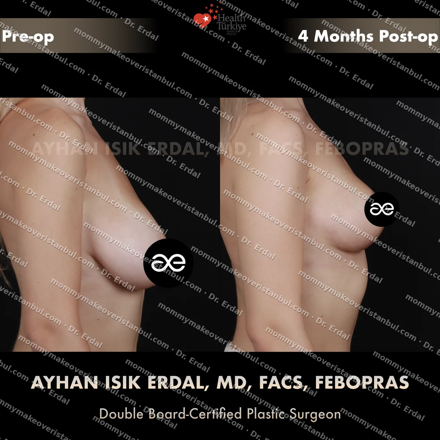 Breast lift (no implants) — patient case blwo-144-de, view side at 4 months post-op