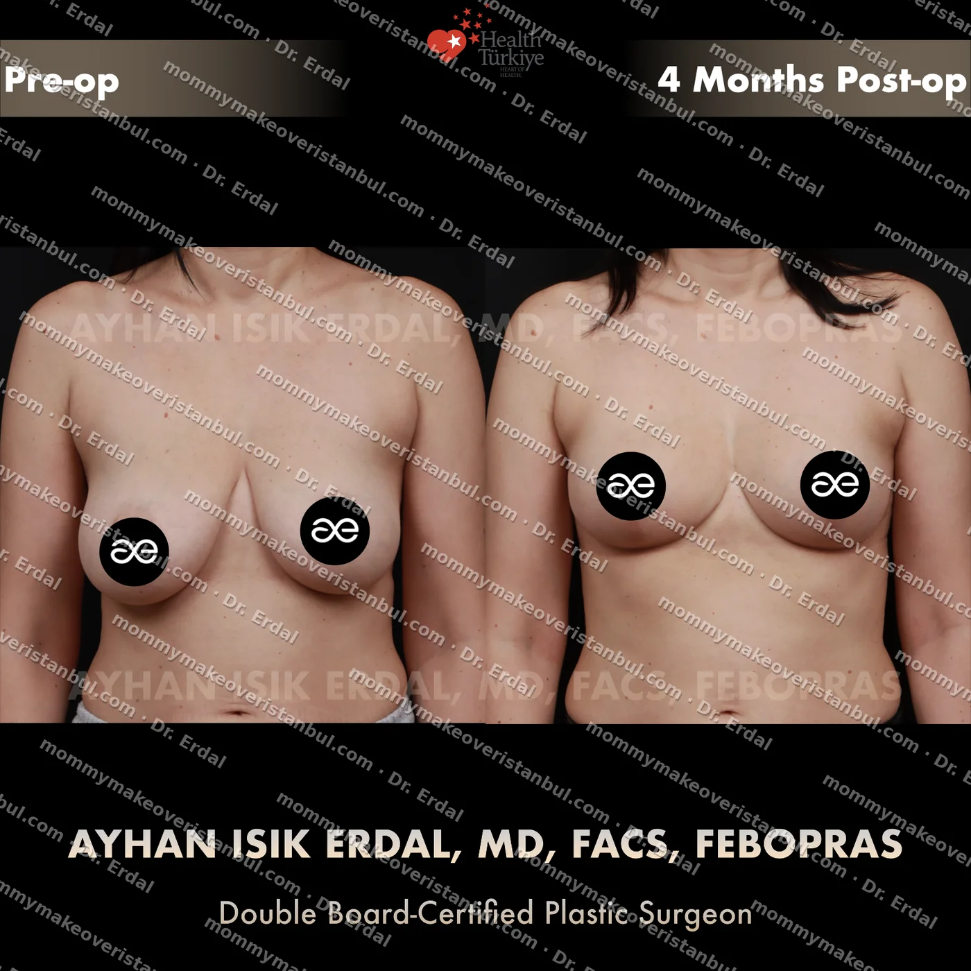 Breast lift (no implants) — patient case blwo-229-nec, view front at 4 months post-op