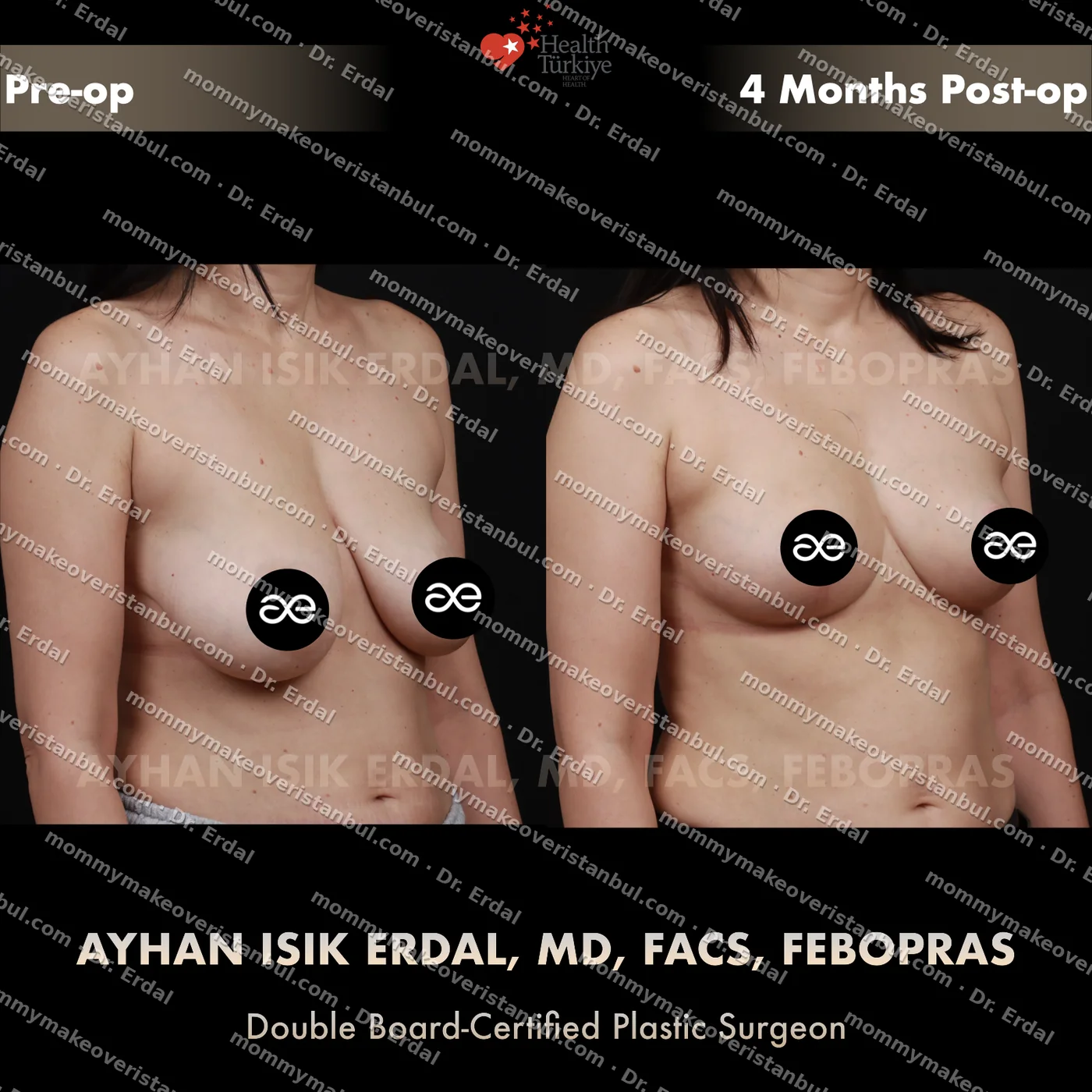 Breast lift (no implants) — patient case blwo-229-nec, view oblique at 4 months post-op