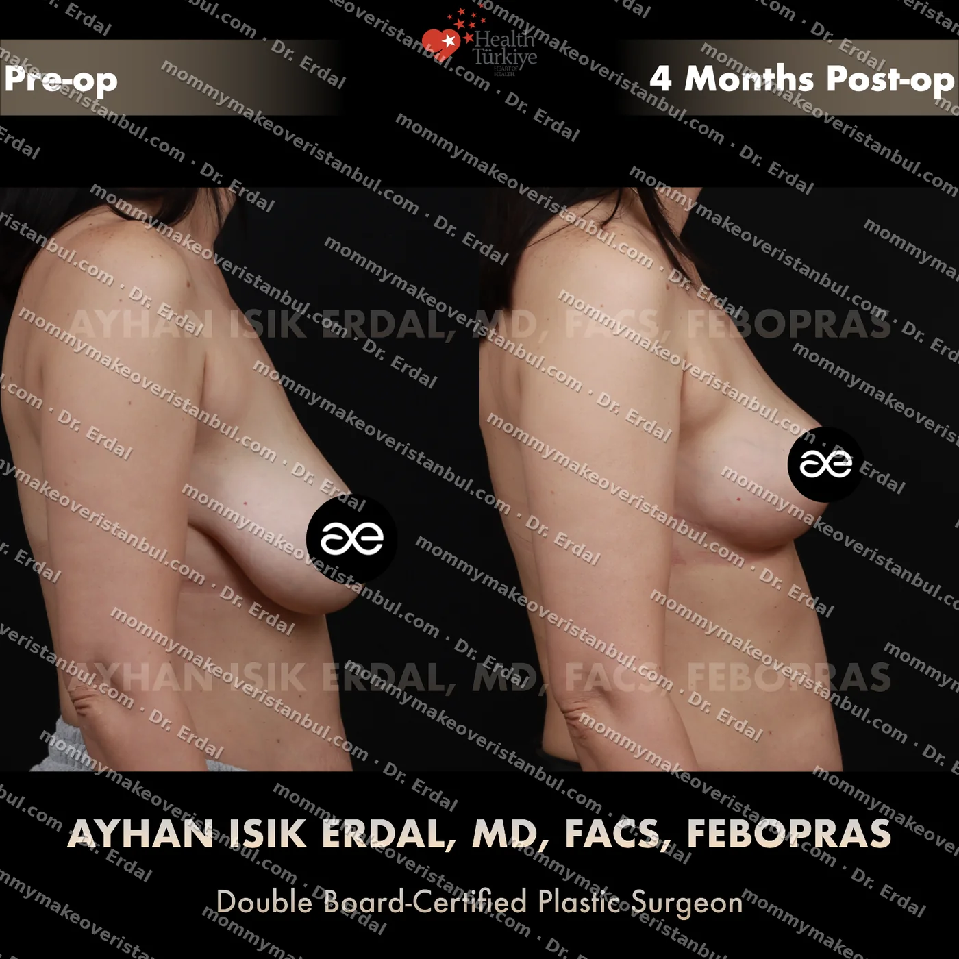 Breast lift (no implants) — patient case blwo-229-nec, view side at 4 months post-op