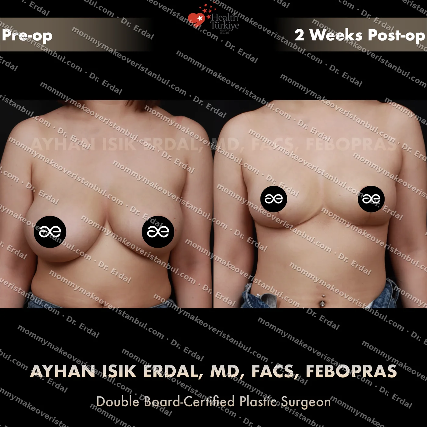 Breast lift (no implants) — patient case blwo-241-ea, view front at 4 months post-op