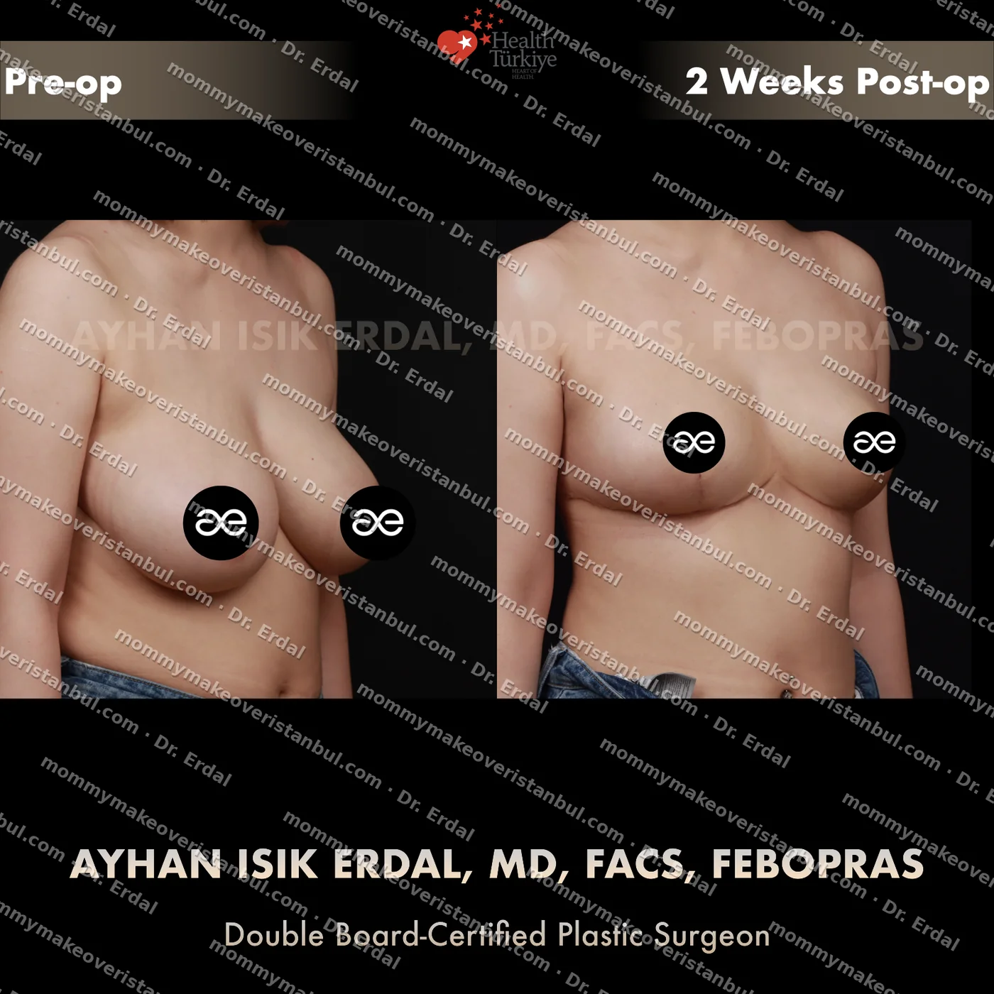 Breast lift (no implants) — patient case blwo-241-ea, view oblique at 4 months post-op