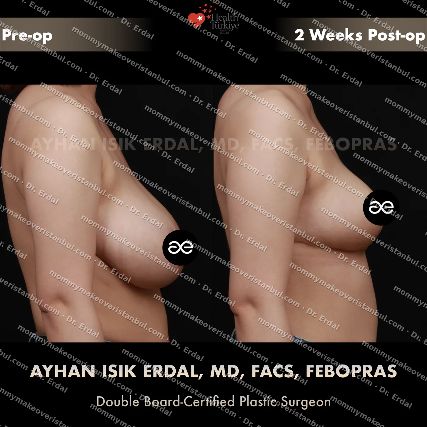 Breast lift (no implants) — patient case blwo-241-ea, view side at 4 months post-op