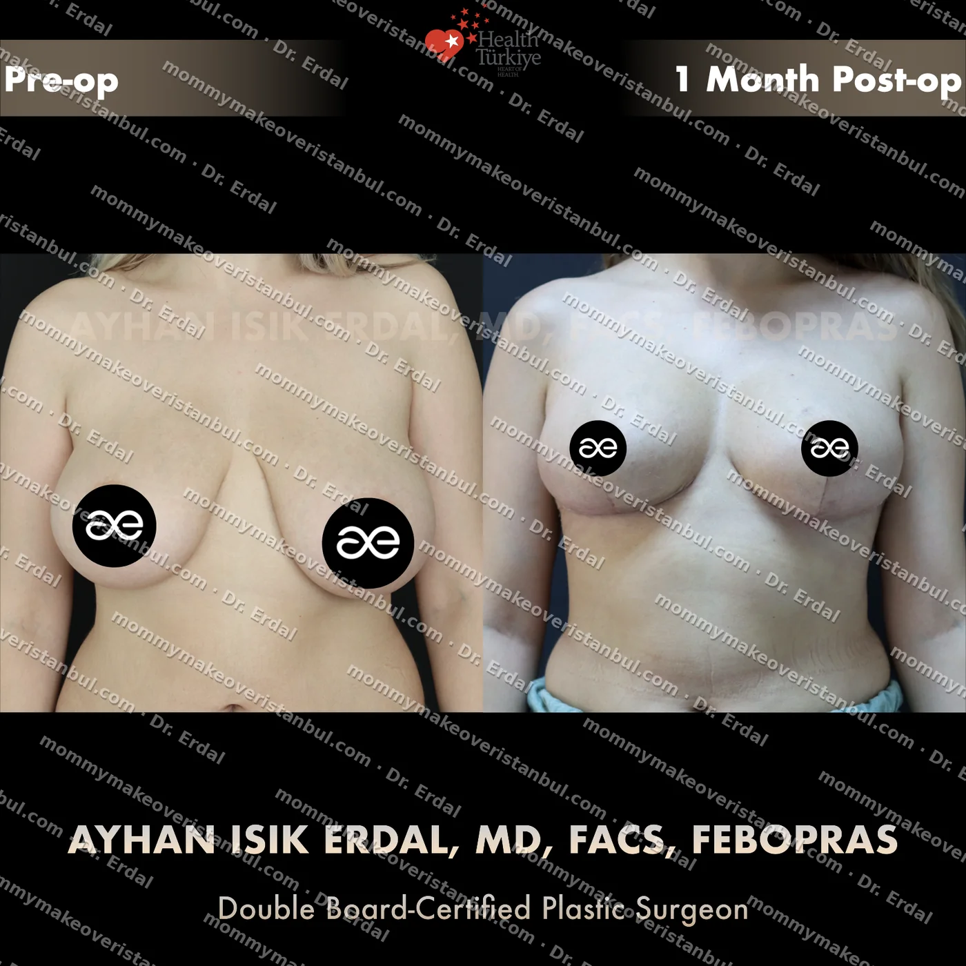 Breast lift (no implants) — patient case blwo-60-ga, view front at 4 months post-op