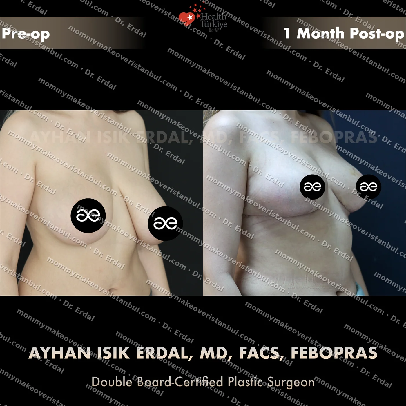 Breast lift (no implants) — patient case blwo-60-ga, view oblique at 4 months post-op