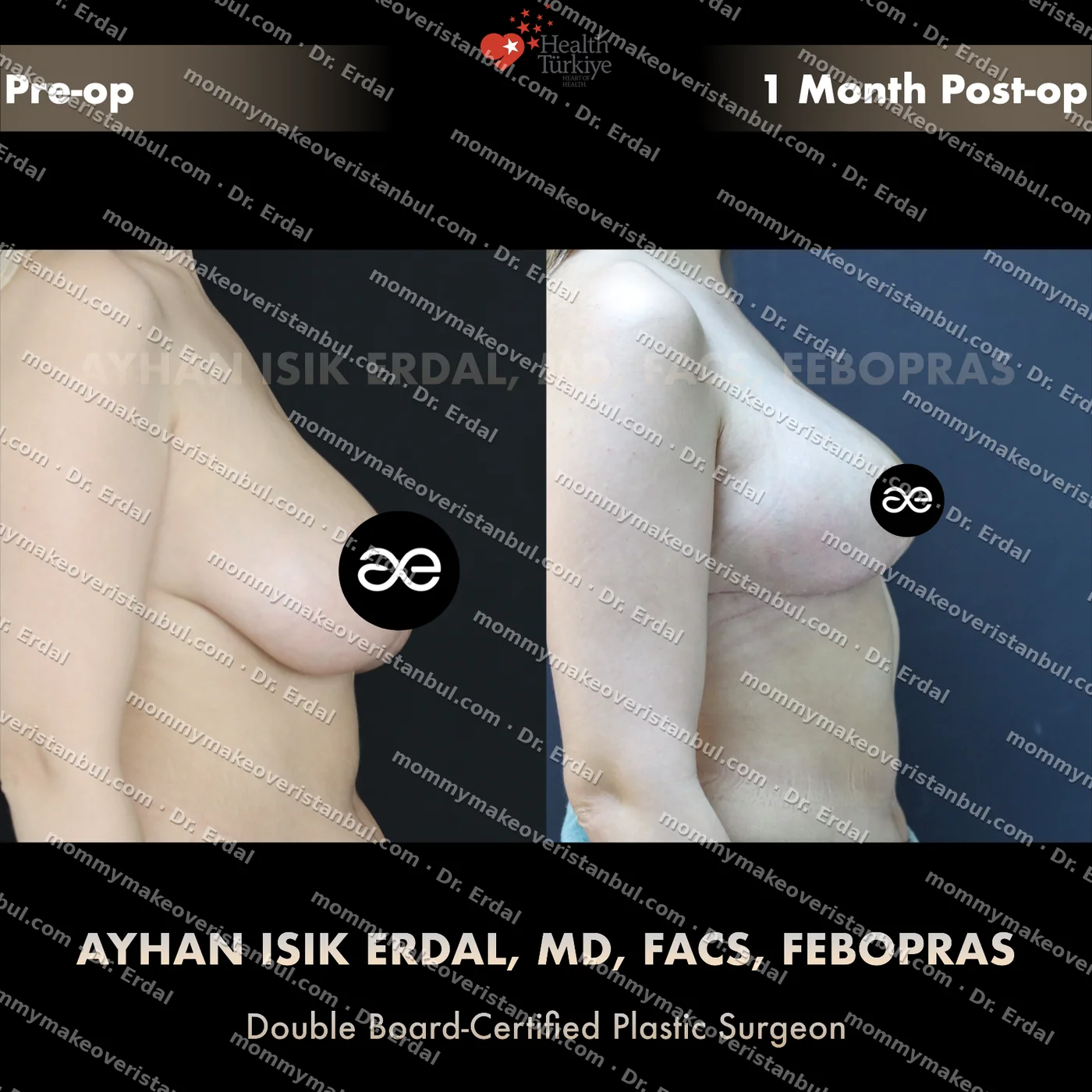Breast lift (no implants) — patient case blwo-60-ga, view side at 4 months post-op
