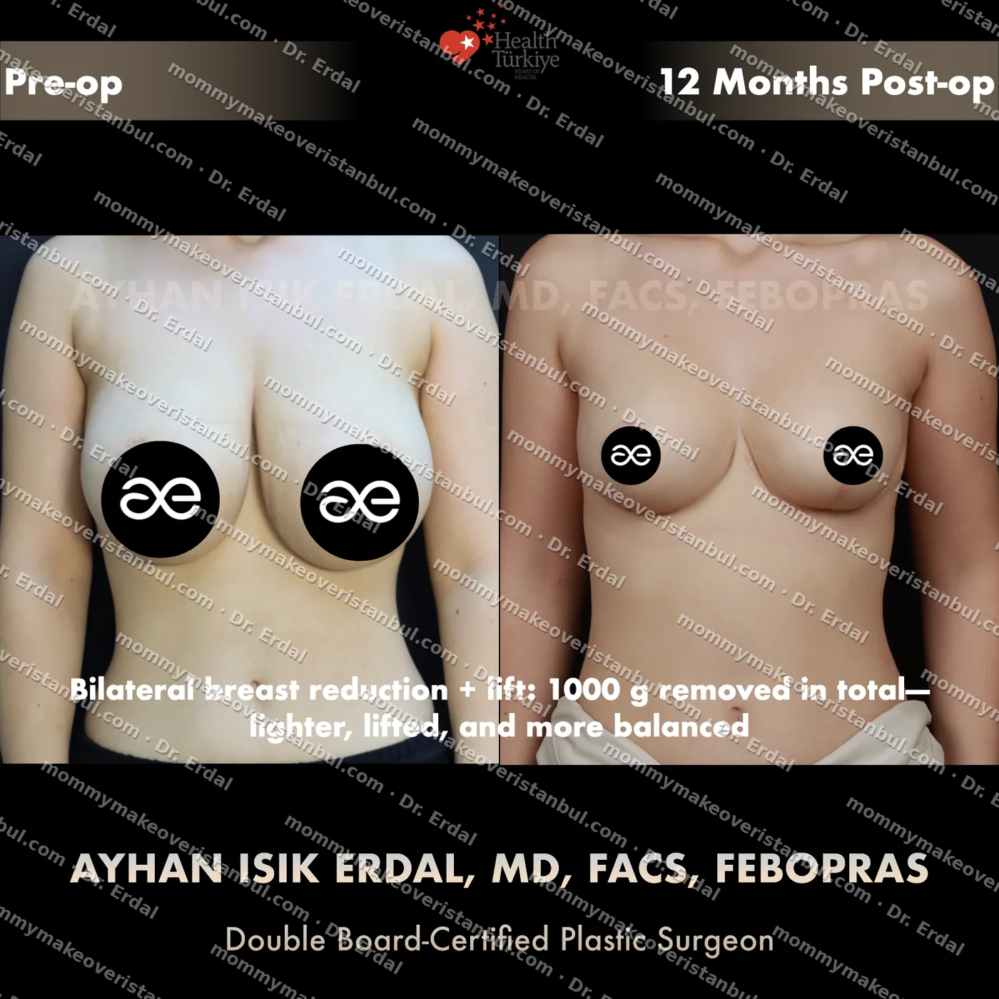 Breast lift (no implants) — patient case blwo-75-ad, view front at 4 months post-op