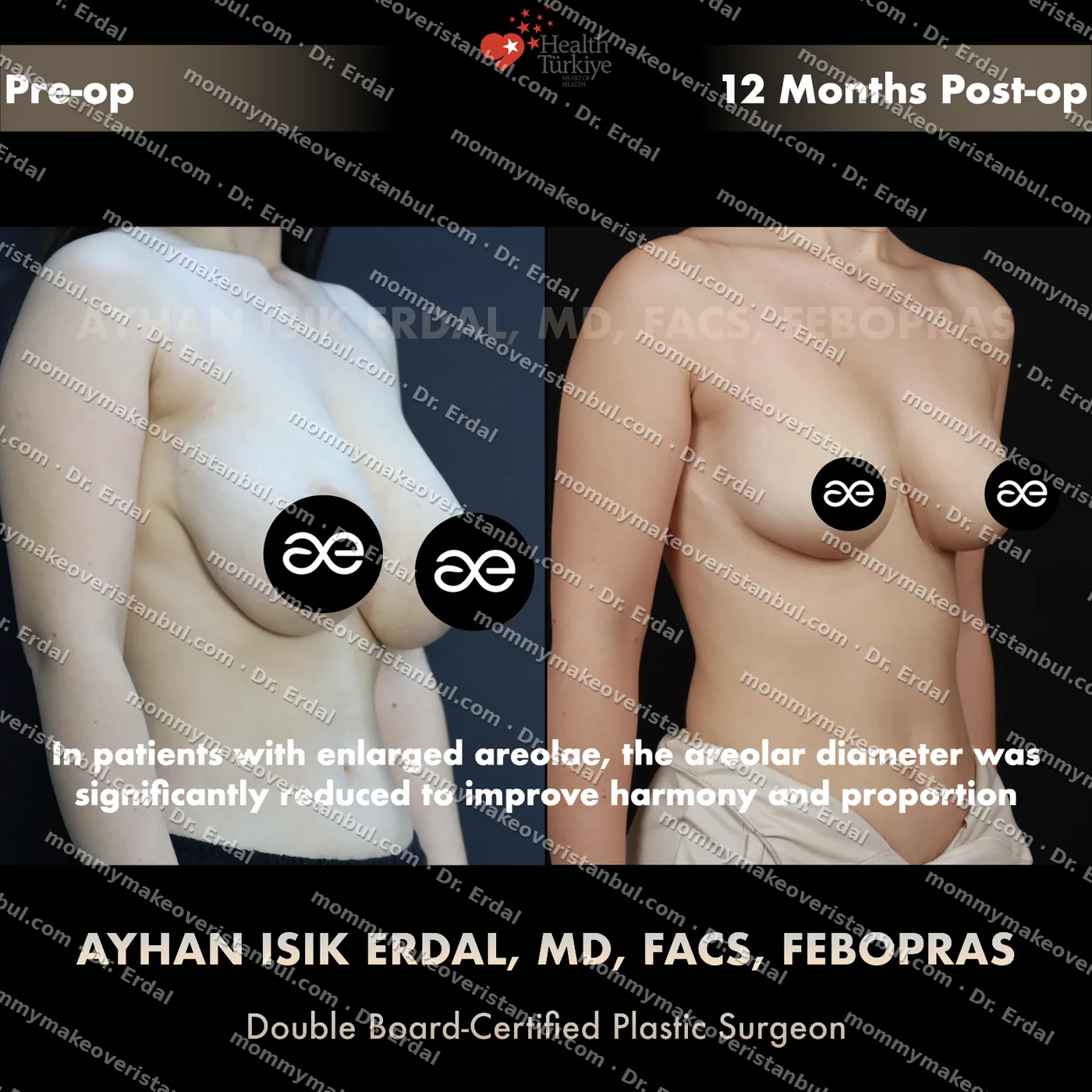 Breast lift (no implants) — patient case blwo-75-ad, view oblique at 4 months post-op