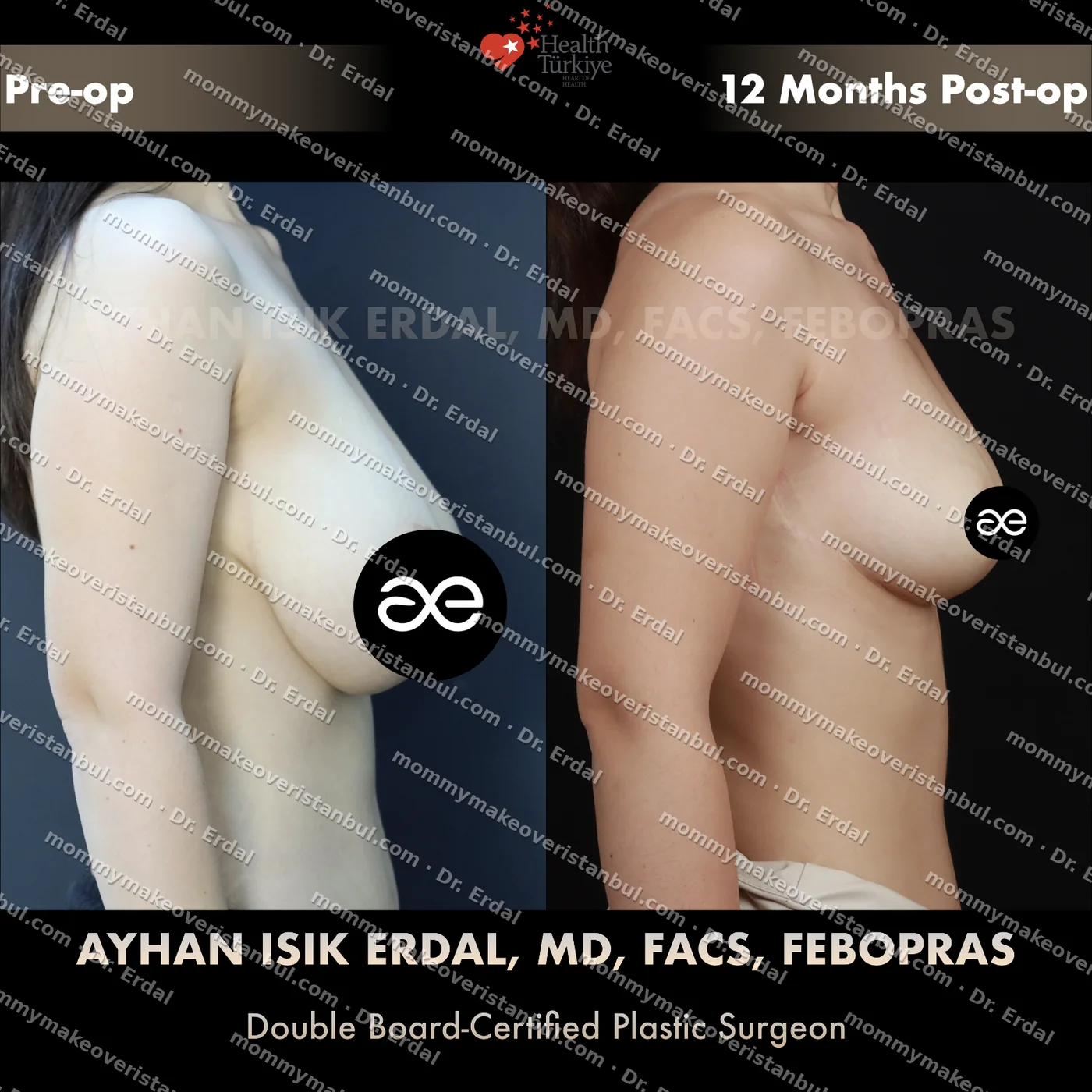 Breast lift (no implants) — patient case blwo-75-ad, view side at 4 months post-op