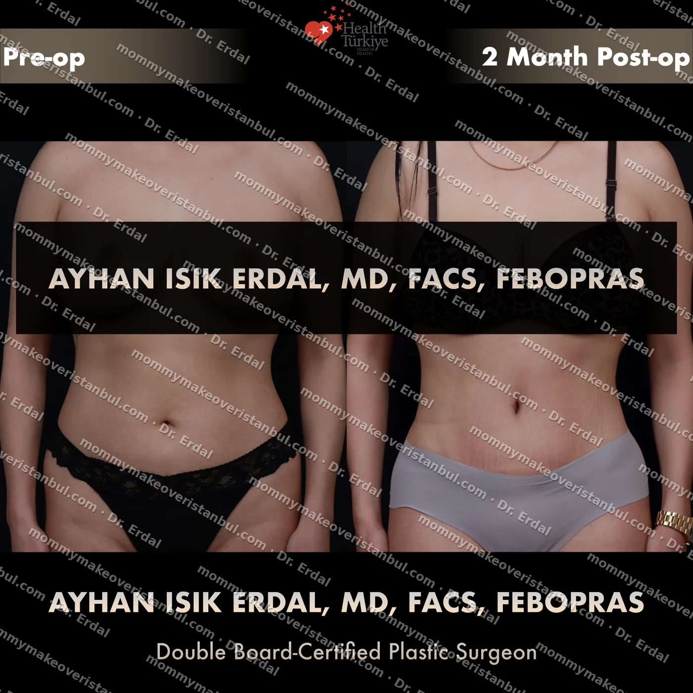 Tummy tuck with diastasis repair — patient case tt-188-syu, view front at 4 months post-op