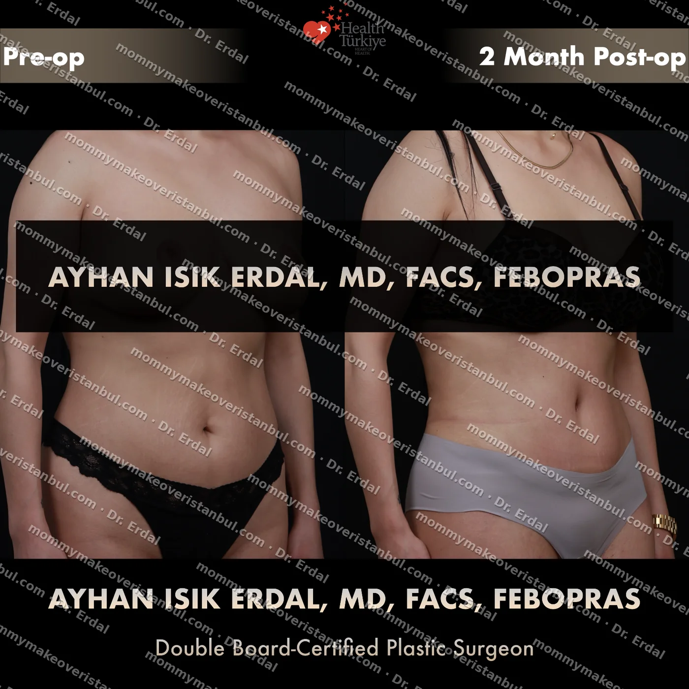 Tummy tuck with diastasis repair — patient case tt-188-syu, view oblique at 4 months post-op