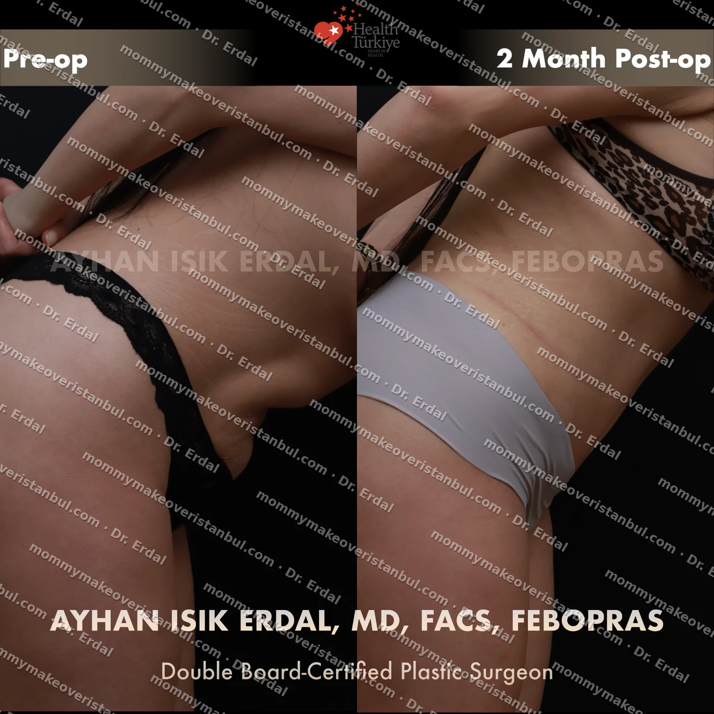 Tummy tuck with diastasis repair — patient case tt-188-syu, view profile at 4 months post-op