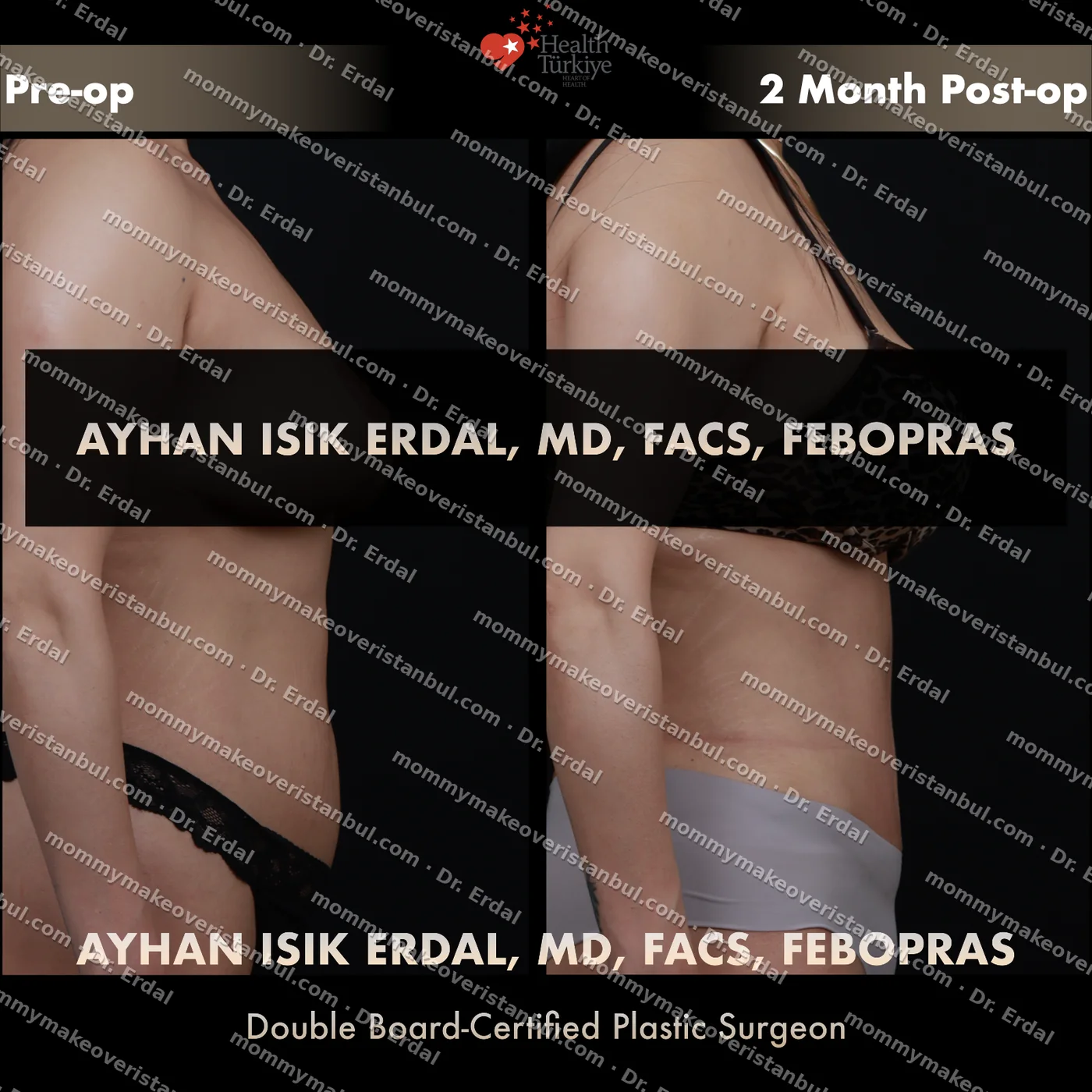Tummy tuck with diastasis repair — patient case tt-188-syu, view back at 4 months post-op