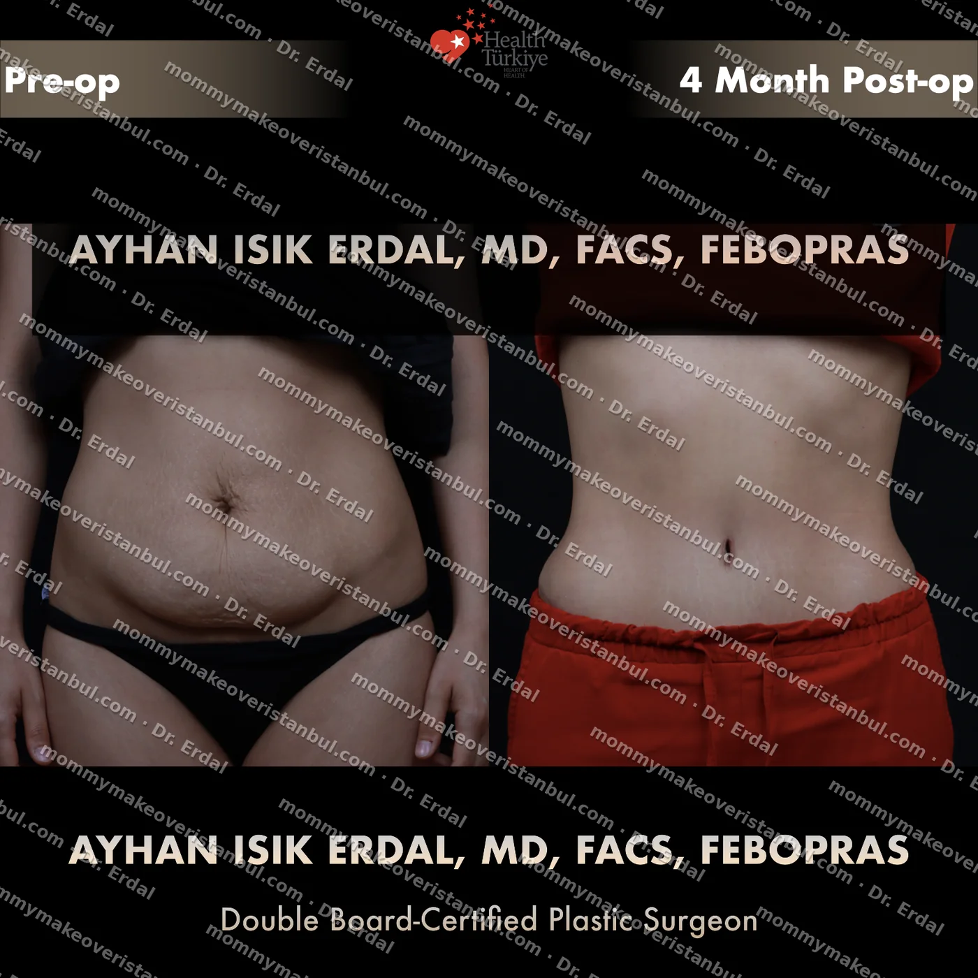 Tummy tuck with diastasis repair — patient case tt-201-od, view front at 4 months post-op