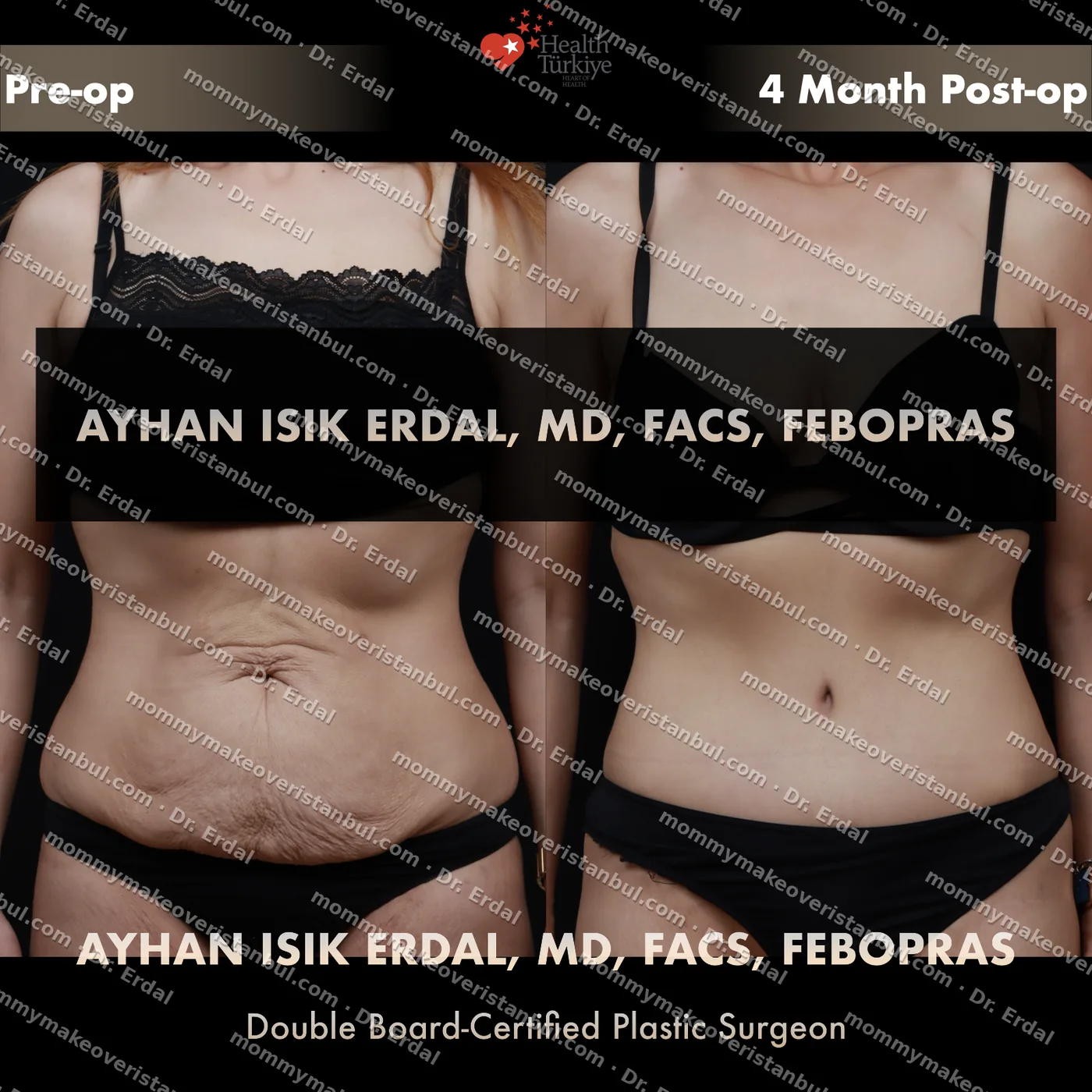 Tummy tuck with diastasis repair — patient case tt-246-kg, view front at 4 months post-op