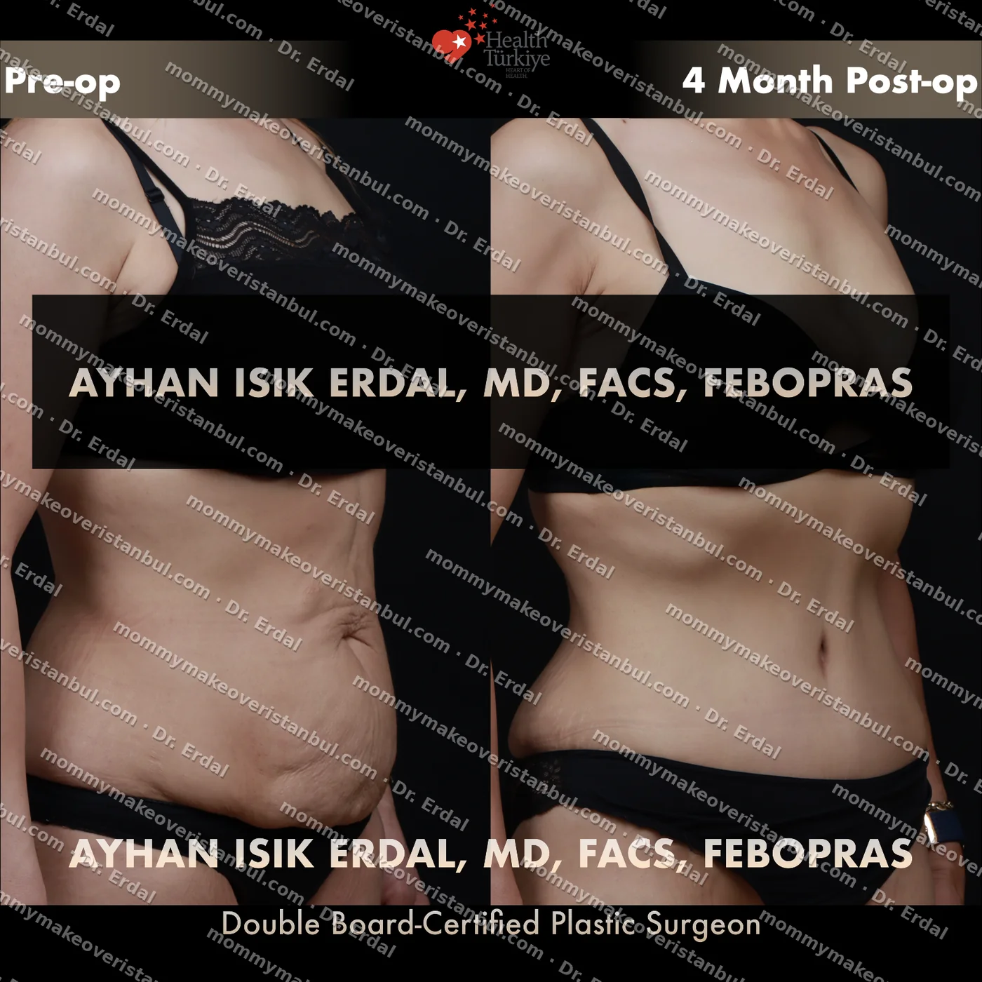 Tummy tuck with diastasis repair — patient case tt-246-kg, view oblique at 4 months post-op