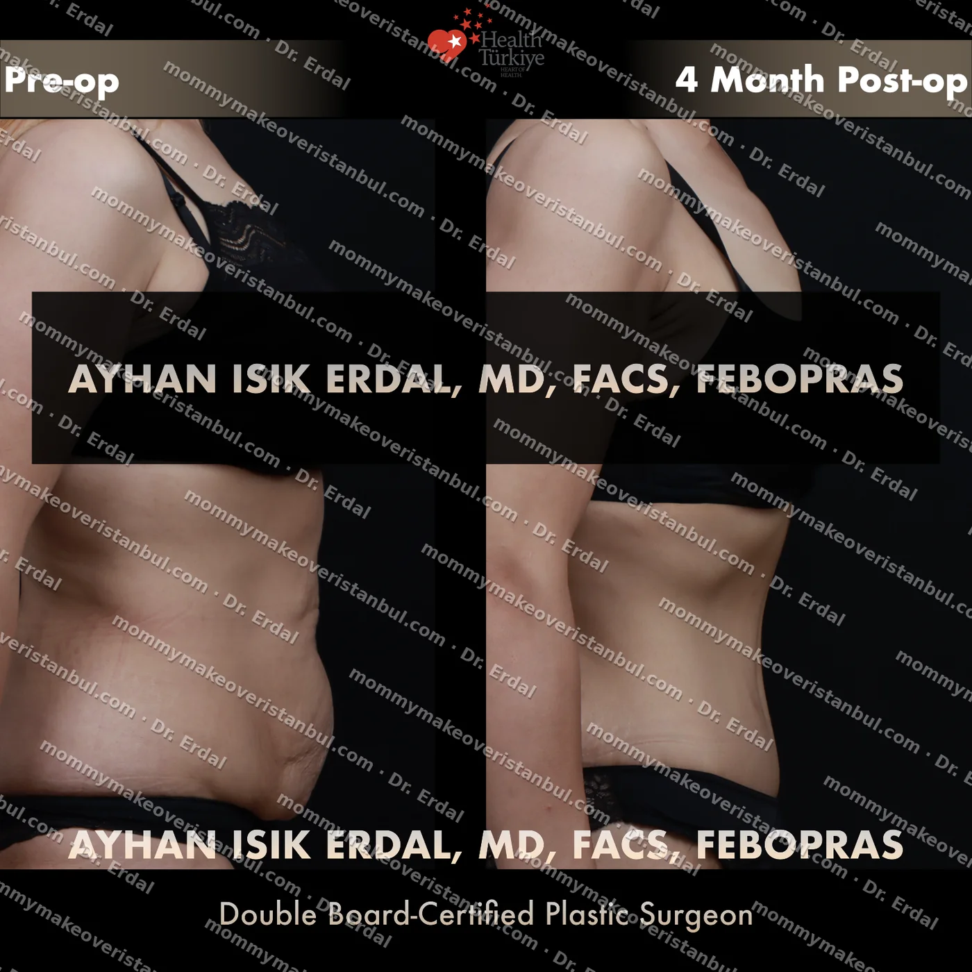 Tummy tuck with diastasis repair — patient case tt-246-kg, view profile at 4 months post-op