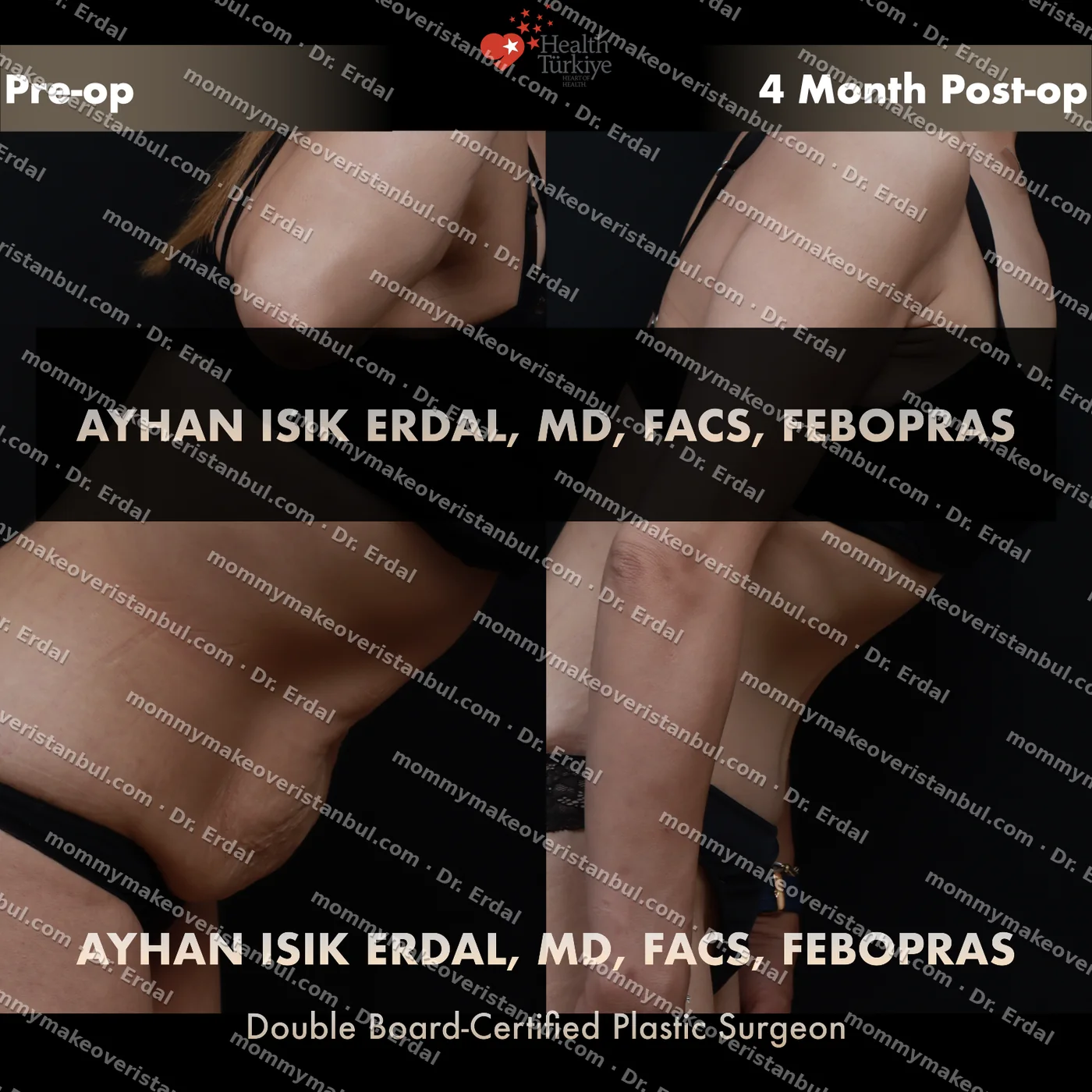 Tummy tuck with diastasis repair — patient case tt-246-kg, view back at 4 months post-op
